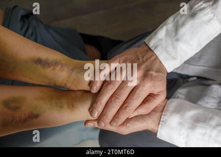 Soutien aux victimes de violence domestique. Main féminine avec des ecchymoses et gros plan de la main du médecin. Banque D'Images