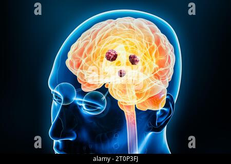 Cancer du cerveau humain avec des cellules cancéreuses ou des tumeurs X ...