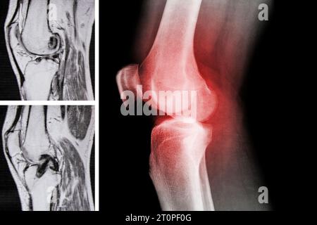 Imagerie par résonance magnétique et radiographie du genou après ablation du ménisque et restauration du ligament croisé, genou Banque D'Images