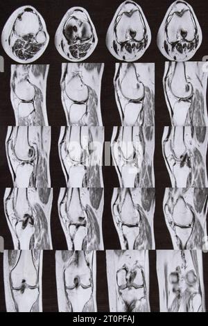 Imagerie par résonance magnétique de l'articulation du genou après ablation du ménisque et reconstruction du ligament croisé de l'articulation du genou, genou après s. Banque D'Images