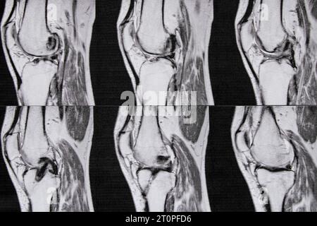 Imagerie par résonance magnétique de l'articulation du genou après ablation du ménisque et reconstruction du ligament croisé de l'articulation du genou, genou après s. Banque D'Images