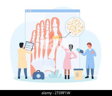 Diagnostic de l'illustration vectorielle de goutte. Les gens minuscules étudient le diagramme médical infographique du pied, les médecins diagnostiquent l'inflammation de l'arthrite et la douleur dans l'articulation articulaire due aux cristaux d'acide urique Illustration de Vecteur