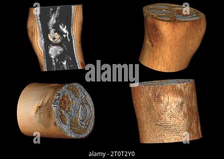 Imagerie par résonance magnétique de l'articulation du genou après ablation du ménisque et reconstruction du ligament croisé de l'articulation du genou, genou après s. Banque D'Images