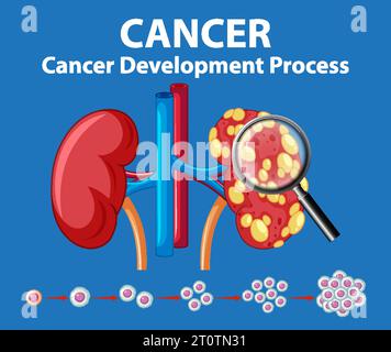 Infographie illustrée illustrant le processus de développement du cancer sur le rein humain Illustration de Vecteur