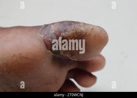 Vue d'angle d'un ulcère du pied diabétique sur la face inférieure d'un gros orteil d'une patiente asiatique diabétique, l'ulcère est maintenant en train de guérir lentement Banque D'Images