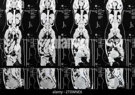 Le Caire, Égypte, octobre 3 2023 : le scanner multi-coupes de l'abdomen et du bassin montre un kyste de l'ovaire droit de 3 x 3 cm, une distension gazeuse colique, pas d'urine importante Banque D'Images