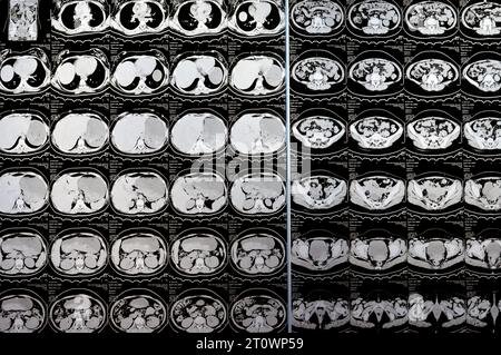 Le Caire, Égypte, octobre 3 2023 : le scanner multi-coupes de l'abdomen et du bassin montre un kyste de l'ovaire droit de 3 x 3 cm, une distension gazeuse colique, pas d'urine importante Banque D'Images