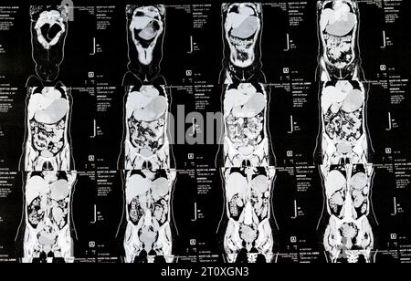 Le Caire, Égypte, octobre 3 2023 : le scanner multi-coupes de l'abdomen et du bassin montre un kyste de l'ovaire droit de 3 x 3 cm, une distension gazeuse colique, pas d'urine importante Banque D'Images