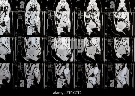 Le Caire, Égypte, octobre 3 2023 : le scanner multi-coupes de l'abdomen et du bassin montre un kyste de l'ovaire droit de 3 x 3 cm, une distension gazeuse colique, pas d'urine importante Banque D'Images