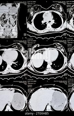 Le Caire, Égypte, octobre 3 2023 : le scanner multi-coupes de l'abdomen et du bassin montre un kyste de l'ovaire droit de 3 x 3 cm, une distension gazeuse colique, pas d'urine importante Banque D'Images