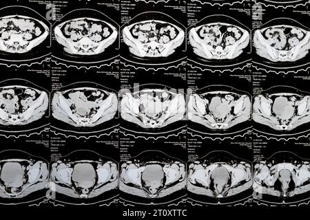 Le Caire, Égypte, octobre 3 2023 : le scanner multi-coupes de l'abdomen et du bassin montre un kyste de l'ovaire droit de 3 x 3 cm, une distension gazeuse colique, pas d'urine importante Banque D'Images