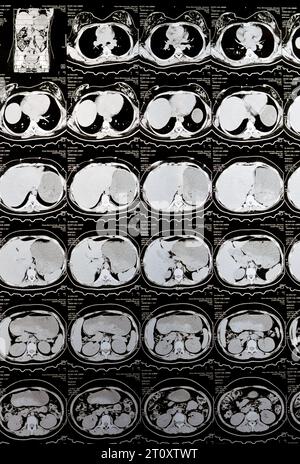 Le Caire, Égypte, octobre 3 2023 : le scanner multi-coupes de l'abdomen et du bassin montre un kyste de l'ovaire droit de 3 x 3 cm, une distension gazeuse colique, pas d'urine importante Banque D'Images