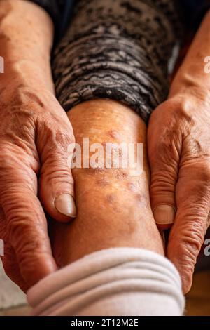 Femme d'Eldery montre la jambe avec la maladie de peau. Maladies des personnes âgées, santé des personnes âgées, ulcères cutanés et psoriasis Banque D'Images