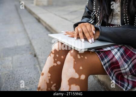 Gros plan des mains et des jambes d'une fille atteinte de vitiligo Banque D'Images