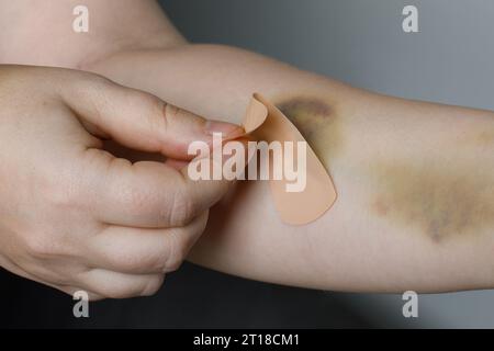 Main avec ecchymose et bande d'aide gros plan Banque D'Images