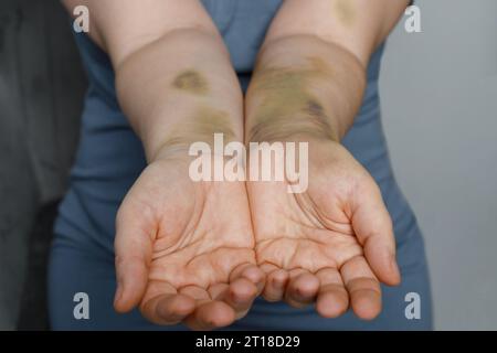 Main féminine avec cicatrice d'accident de voiture. Main féminine avec ecchymose Banque D'Images