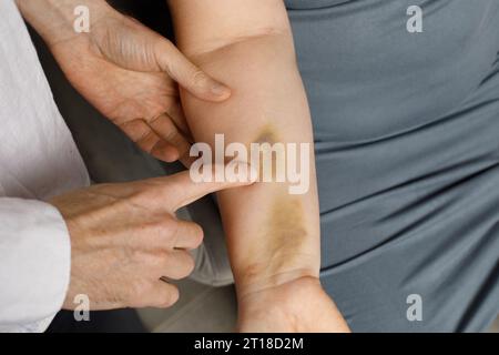Femme au bras meurtri au cabinet du médecin Banque D'Images