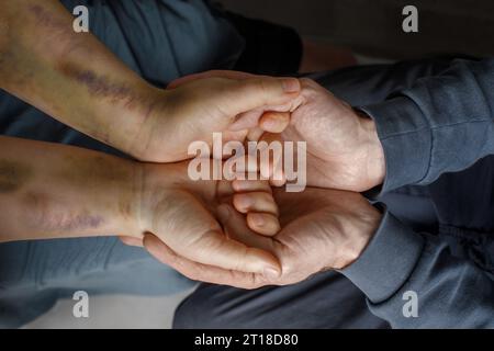 Main humaine avec ecchymoses dans une autre main humaine. Soutien aux victimes de violence domestique. Banque D'Images