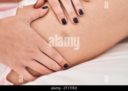 Jeune femme blonde touchant la jambe avec hématome dans la chambre Banque D'Images