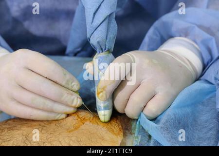 Chirurgie médicale de la photocoagulation endoveineuse au laser de la grande veine saphène. Miniphlegectomie. Veine endoveineuse de coagulation laser. Banque D'Images