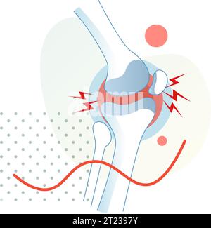 Articulation du genou - douleur - Illustration stock comme fichier EPS 10 Illustration de Vecteur