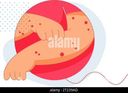 Enfant au lit avec Chickenpox - Illustration stock comme fichier EPS 10 Illustration de Vecteur