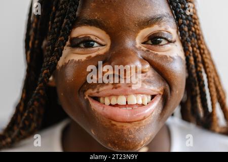 Gros plan portrait de jeune femme avec le sourire vitiligo à la caméra Banque D'Images