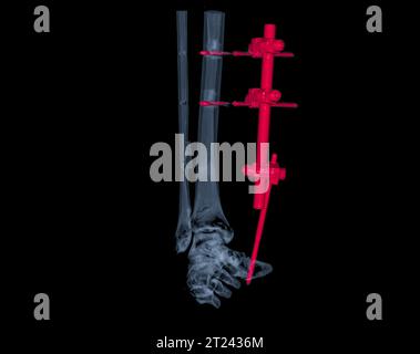 Image de rendu 3D de l'articulation de la cheville par tomodensitométrie montrant la fracture du tibia et du péroné avec une plaque et une fixation par vis pour maintenir les os en place et aider Banque D'Images