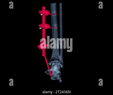 Image de rendu 3D de l'articulation de la cheville par tomodensitométrie montrant la fracture du tibia et du péroné avec une plaque et une fixation par vis pour maintenir les os en place et aider Banque D'Images