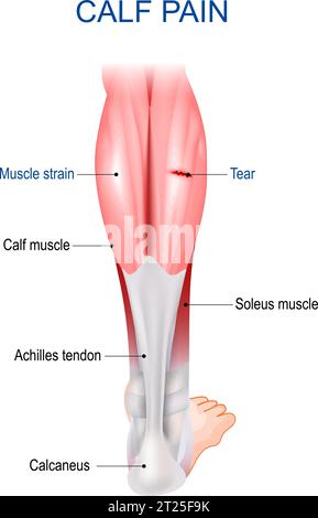 Douleur du mollet. Anatomie musculaire du mollet. Structure musculaire d'un lerg humain. Infographie médicale. Illustration vectorielle Illustration de Vecteur