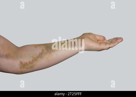 Traumatisme ecchymose d'accident de voiture sur peau féminine Banque D'Images