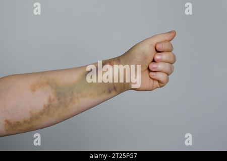 Ecchymose d'accident de voiture sur la peau de la femme Banque D'Images