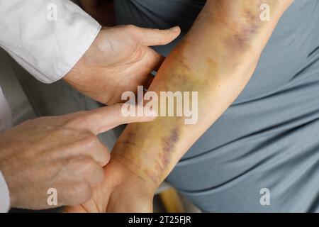 Femme avec une main contusionnée au cabinet du médecin Banque D'Images