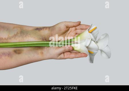 Main féminine avec des problèmes bleus tenant la fleur de lys blanc délicat. Violence domestique et abus contre les femmes concept de problème social. Banque D'Images