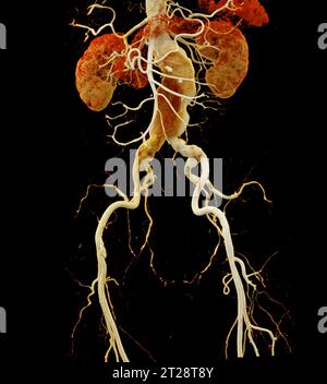 CTA aorte abdominale montrant un rendu 3D de dissection aortique abdominale. Banque D'Images