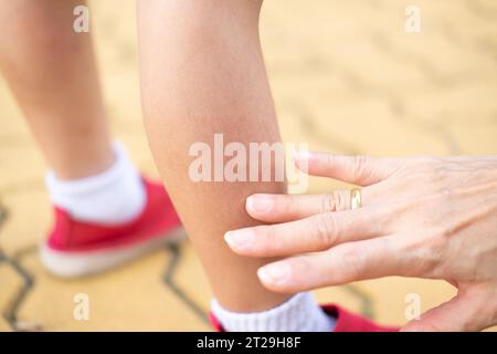 La main d'une mère applique un médicament pour soulager les démangeaisons d'une éruption cutanée de piqûre de moustique sur la jambe d'un enfant. Banque D'Images
