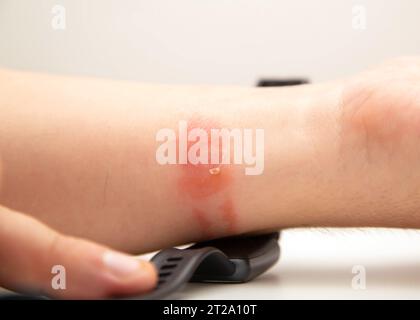 Irritation, rougeur et démangeaisons sur la peau après avoir porté une montre ou un bracelet fitness. Allergie au bracelet de montre, dermatite de contact. Banque D'Images