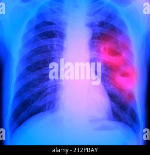 Abcès pulmonaires, radiographie Banque D'Images