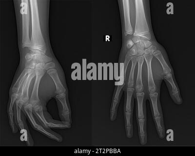 Main saine, radiographie Banque D'Images