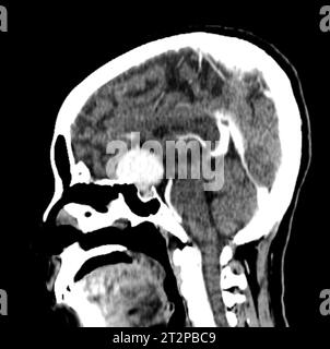 Masse sellaire, tomodensitométrie Banque D'Images