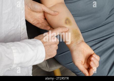 Grande contusion sur le bras humain. Ecchymoses d'injection. Médecin et patient à l'intérieur Banque D'Images
