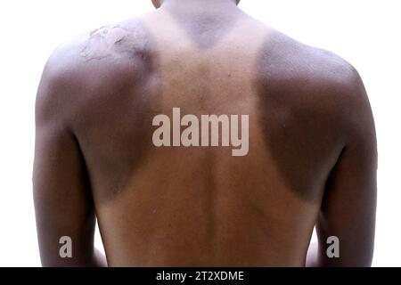 Peau foncée et rash après avoir eu l'exposition au soleil aux rayons UV extérieur peau rouge et démangeaison peeling pour la peau humaine et le concept de santé, blanc isolé Banque D'Images