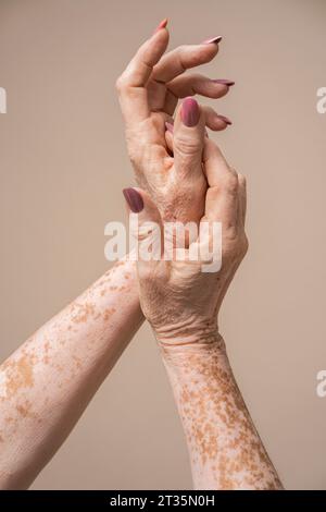 Mains de femme âgée avec vitiligo sur fond rose Banque D'Images