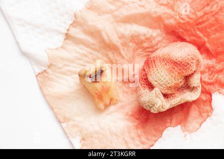 Une dent extraite avec un trou noir au milieu de la dent, gros plan sur le fond d'un bandage avec du sang, une dent malade après extractio Banque D'Images
