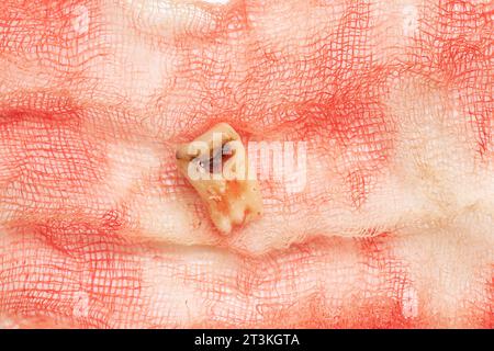 Une dent extraite avec un trou noir au milieu de la dent, gros plan sur le fond d'un bandage avec du sang, une dent malade après extractio Banque D'Images