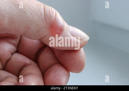 Kyste ganglionnaire (kyste synovial) sur le pouce de la main d’une femme. Mise au point sélective. Banque D'Images