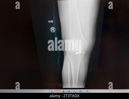 Radiographie médicale de la rotule réparée de l'adulte moyen Banque D'Images