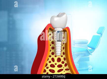 Le concept d'implant dentaire sur le fond médical. illustration 3d. Banque D'Images