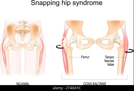 Syndrome de la hanche à claquer. Coxa saltans. tendinite iliopsoas. la hanche du danseur. Anatomie d'une hanche humaine. Illustration vectorielle Illustration de Vecteur