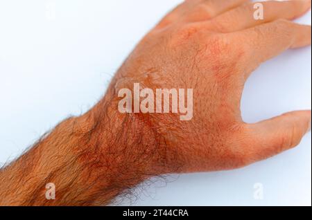 La main d'un homme brûlait avec de l'eau bouillante. Dessus, il y a des rougeurs et des cloques. Banque D'Images